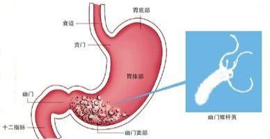 去除幽门螺杆菌需要多少钱