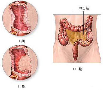 肠梗阻患者需要做哪些检查